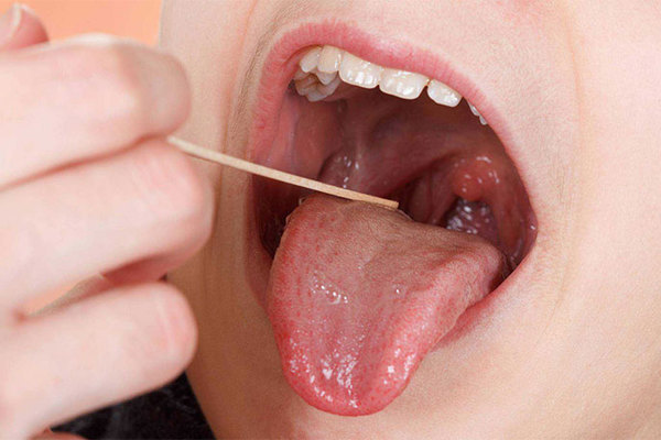 Ung thư lưỡi ngày càng phổ biến, bác sĩ cảnh báo 4 nguyên nhân gây bệnh