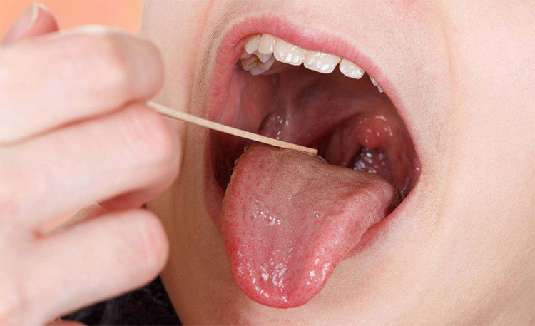 Ung thư lưỡi ngày càng phổ biến, bác sĩ cảnh báo 4 nguyên nhân gây bệnh
