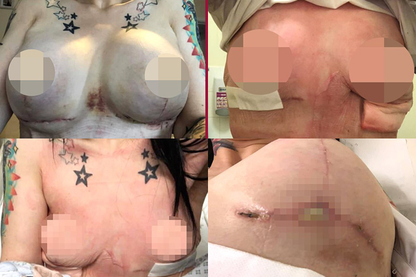 Ra nước ngoài nâng ngực, cô gái trẻ phải cắt bỏ 2 bên vú