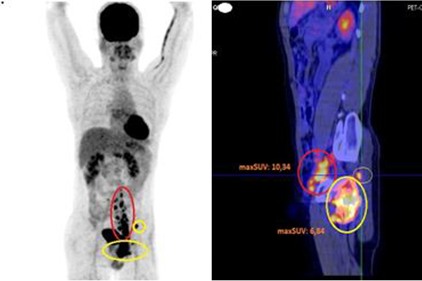 Đi khám vì đau háng, phát hiện tế bào ung thư chạy khắp người - Ảnh 2.