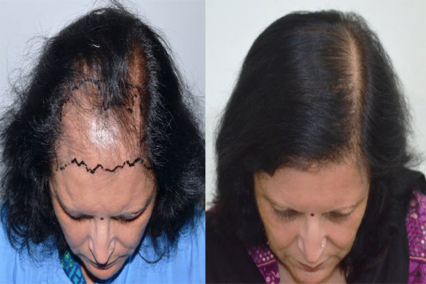 Phương pháp cấy tóc chữ M tăng vẻ nam tính cho nam giới