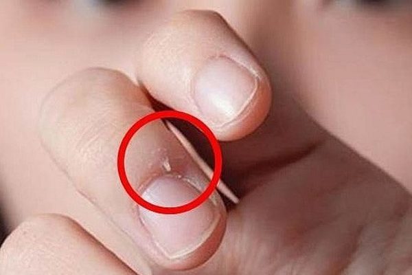 Ngón tay người đàn ông 'chứa' đầy tế bào ung thư, thủ phạm là hành động nhỏ bạn thường làm