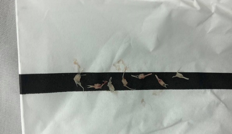 Bé gái 16 tháng bị hóc 7 chiếc xương cá