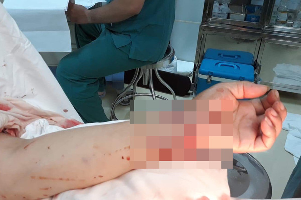 Tạm giữ nghi phạm chém đứt lìa tay người phụ nữ trong tiệc tất niên