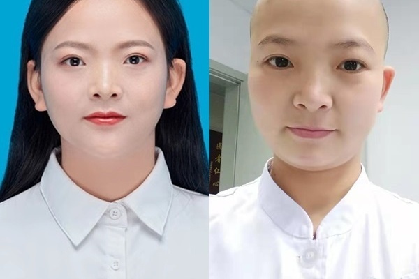 Bác sĩ Vũ Hán mặt hằn khẩu trang, đầu cạo trọc vì chống dịch corona