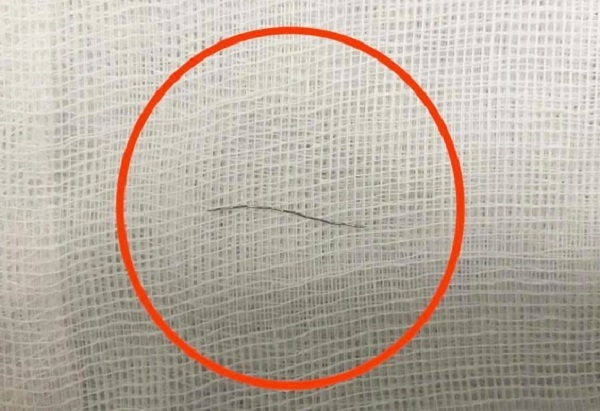 Ăn cháo nấu sẵn, bé 13 tháng tuổi bị mảnh thép rây lọc cháo cắm sâu vào thành họng