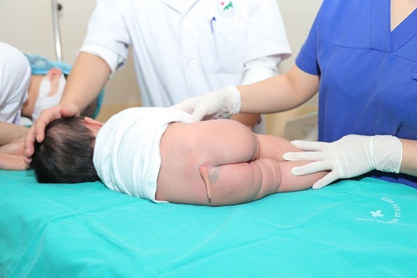 Bé 5 tháng tuổi ở Hà Nội có dị tật còn đuôi bẩm sinh hiếm gặp