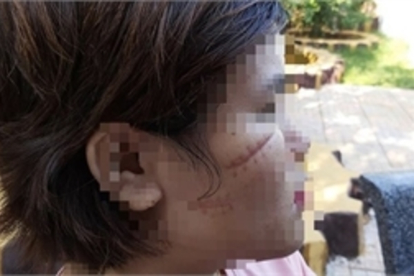 Bắt khẩn cấp nghi can chặn xe rạch mặt cô gái 26 tuổi ở Bà Rịa - Vũng Tàu