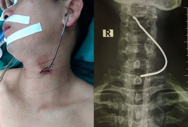 Người đàn ông bị thanh sắt đâm vào cổ do xe tải bên đường bất ngờ nổ lốp,