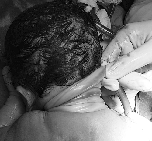 Bé trai chào đời với dây rốn quấn chặt quanh cổ 4 vòng hiếm gặp