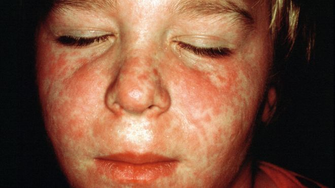 Measles resurgence fear amid coronavirus