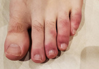 ‘Ngón chân Covid’, triệu chứng lạ ở bệnh nhân nhiễm nCoV