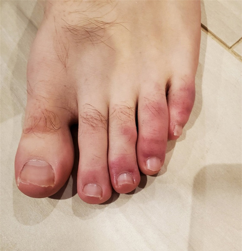 ‘Ngón chân Covid’, triệu chứng lạ ở bệnh nhân nhiễm nCoV