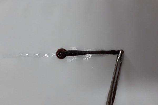 Con đỉa dài 5 cm chui trong mũi người phụ nữ