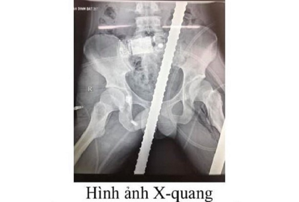 Cứu sống thanh niên bị 2 thanh sắt đâm xuyên tầng sinh môn, bụng, ngực, đùi