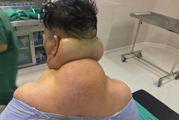 Người đàn ông biến dạng cơ thể do nghiện rượu nhiều năm