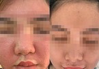 Cô gái 21 tuổi nhận cái kết đắng khi đắp mặt nạ đông y làm trắng da