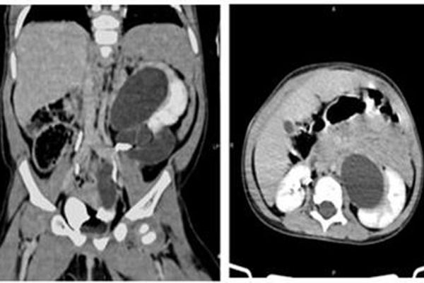 Bé gái hơn 1 tuổi ở Phú Thọ có 3 quả thận