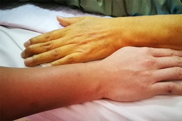 Chỉ một vài thay đổi nhỏ của màu da cũng tiết lộ nhiều bệnh nguy hiểm