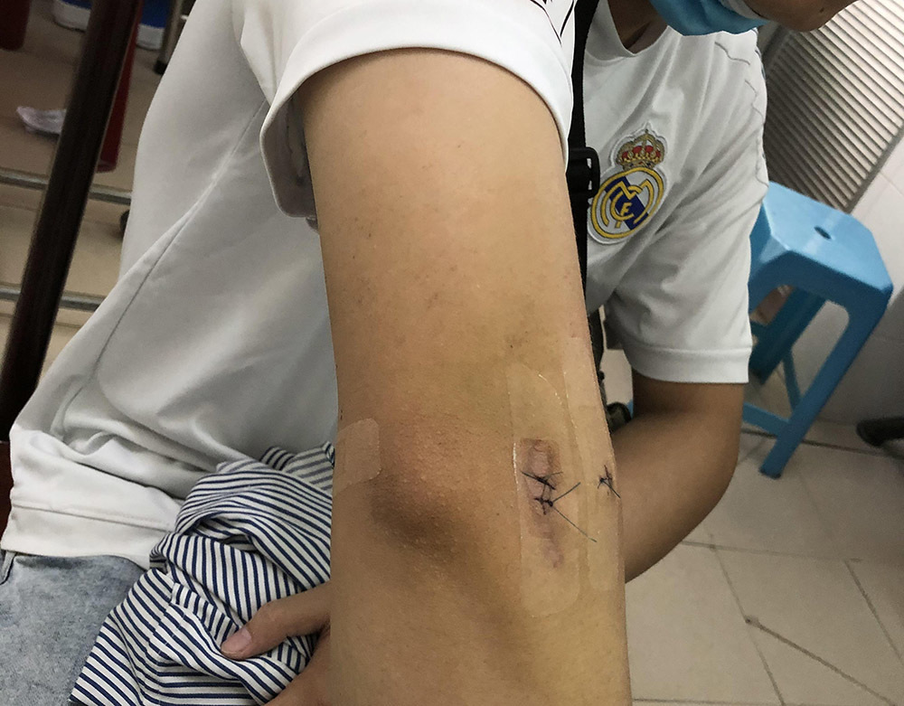 Cứu cánh tay cho chàng trai trẻ bị mà viêm mỏm trên lồi cầu ngoài