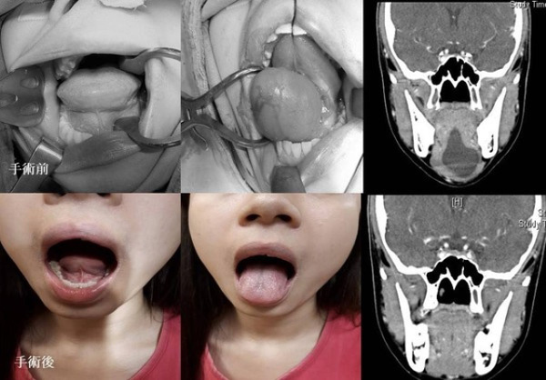 Cô gái nói chuyện không ai hiểu, đi khám phát hiện ra có khối u