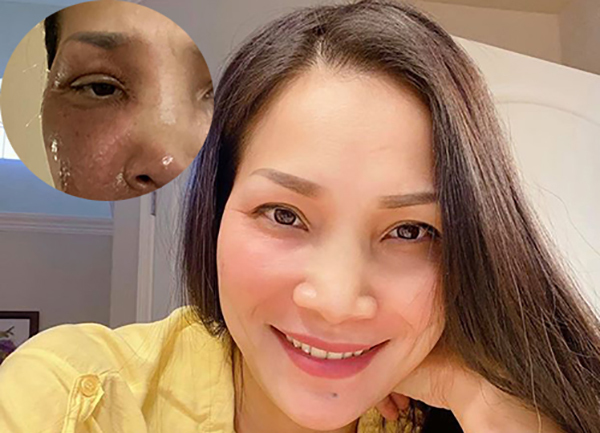 Hồng Ngọc bình phục hoàn toàn sau bỏng nặng
