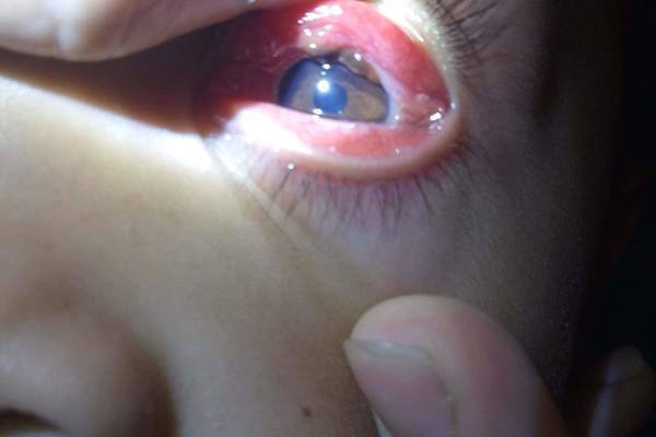 Gắp một con vắt sống trong mắt bệnh nhân 8 tuổi
