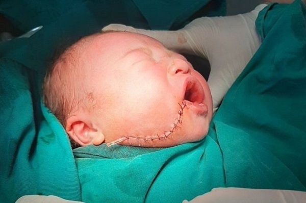 Sinh tại nhà, trẻ sơ sinh rách mặt vì rơi vào dao cắt rốn