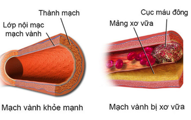 Gia đình có 28 người mắc cholesterol di truyền, có thể chết trước tuổi 20