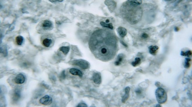 Brain-eating amoeba: Warning issued in Florida after rare infection case