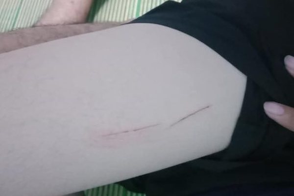 Nữ sinh TP.HCM bị kẻ lạ rạch đùi trên đường đi học về