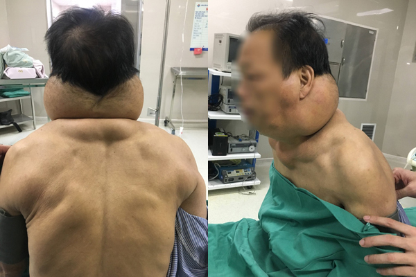 Quý ông biến dạng vùng cổ do nghiện rượu