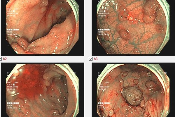 Người phụ nữ phải cắt ruột vì tế bào ung thư ken đặc