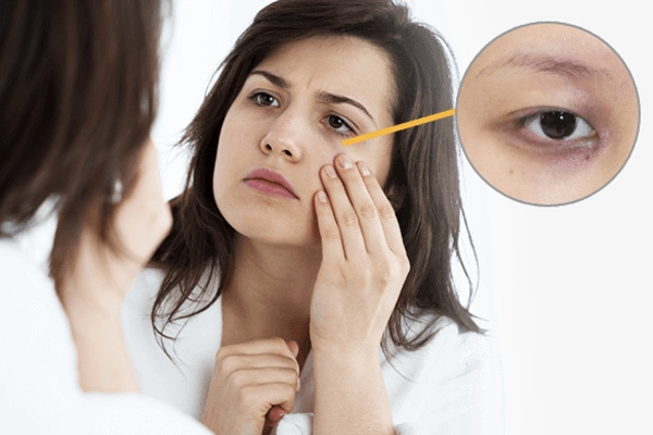 Quầng mắt thâm là dấu hiệu của 5 bệnh nguy hiểm