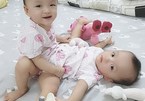 Conjoined twins successfully separated in Ho Chi Minh City