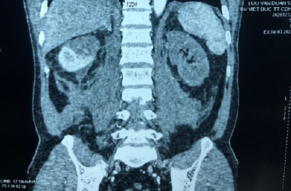 Mang thận ra rửa rồi ghép lại vào cơ thể bệnh nhân