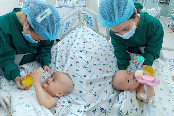 Sau 20 ngày mổ tách, hai bé song Nhi đã tự thở