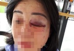 Nữ tiếp viên xe buýt ở Sài Gòn bị hành khách đánh sưng mắt