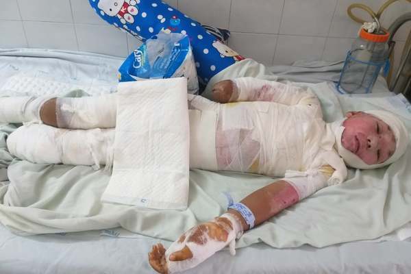 Bị bỏng điện nặng, cậu bé 12 tuổi buộc phải cắt bỏ tay chân