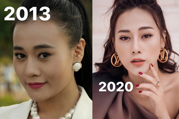Phương Oanh công khai ảnh trước và sau khi phẫu thuật