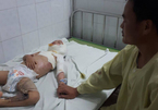 Bé trai 4 tuổi bị bỏng cồn nặng cần giúp đỡ khẩn cấp