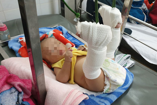 Bé trai 4 tháng tuổi bị cha đánh gãy chân vì không chịu ngủ