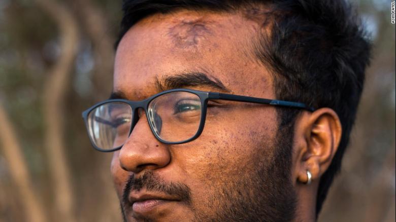 Từ đứa trẻ từng vỡ xương sọ tới thần đồng toán học thế giới