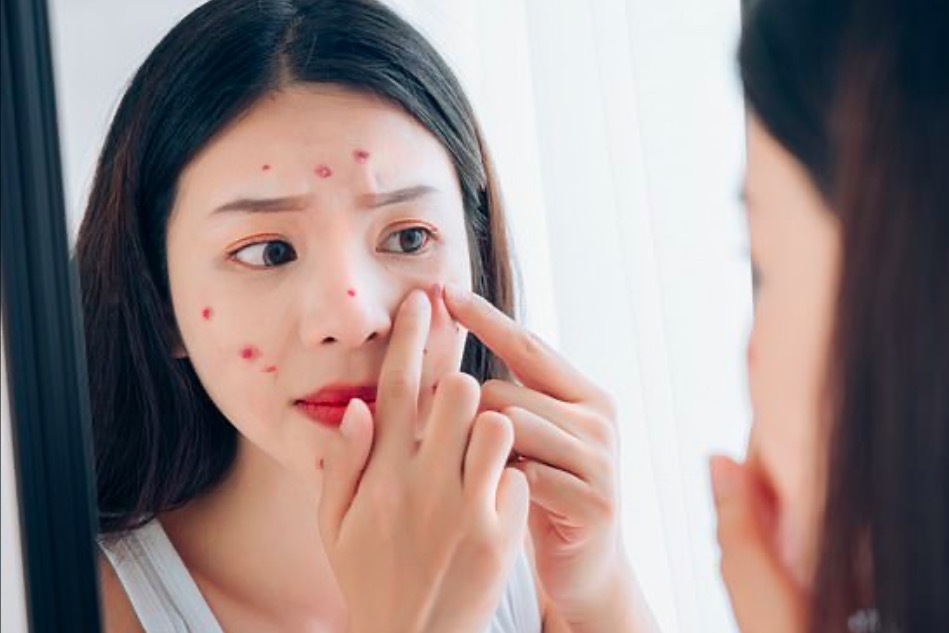 Nặn mụn trên mặt, thiếu nữ nhiễm trùng não nguy kịch