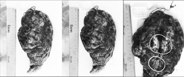 Patient found with two types of cancer in same lung