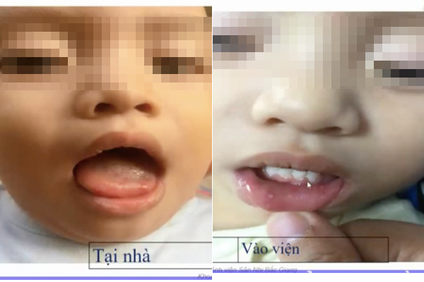 Bé 1 tuổi mắc tay chân miệng tổn thương não, 3 dấu hiệu sớm báo bệnh nặng