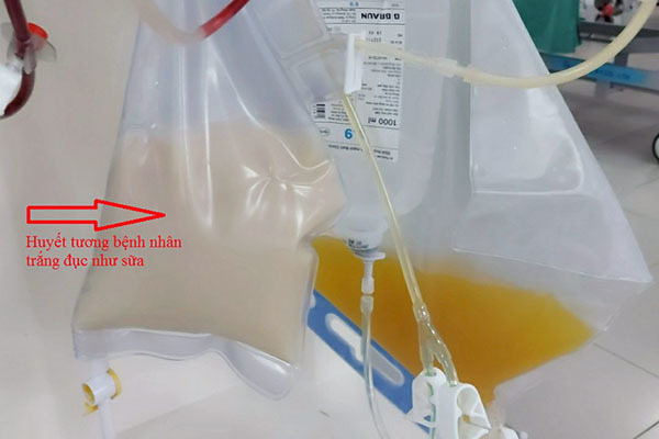 Nữ bệnh nhân bị viêm tụy có huyết tương trắng đục như sữa