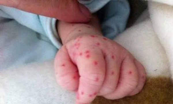 Vietnam poised to enter peak season for dengue fever in October and November