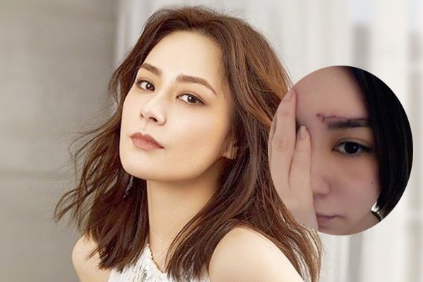 Ngã trong nhà vệ sinh, Chung Hân Đồng phải khâu hơn 60 mũi