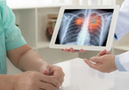 Các triệu chứng gây bất ngờ của ung thư phổi